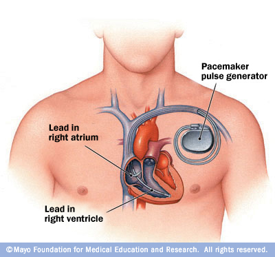 hb7_pacemaker.jpg